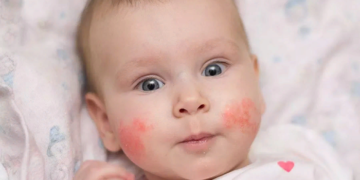 Аллергия у детей причины симптомы и способы диагностики