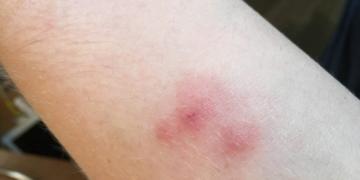 Методы и правила борьбы с земляными блохами