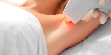 Особенности и преимущества лазерной эпиляции