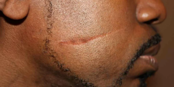 Как идеально замаскировать шрам на лице и советы