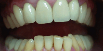 Основные плюсы металлопластмассовых коронок и их установка