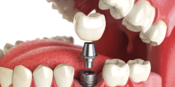 Установка и основные правила протезирования зубов