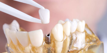 Порядок выполнения работ при имплантации зубов