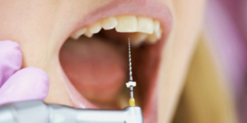 Правила удаления зубного нерва и способы