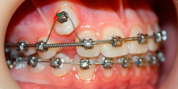 Как поставить брекеты взрослому: правила и этапы