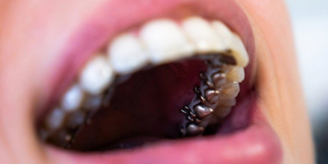 Лингвальные брекеты: понятие, достоинства и особенности