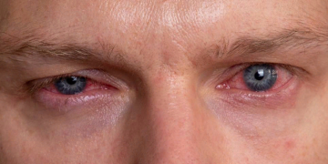 Кон’юнктивіт: поняття, симптоми та як лікувати