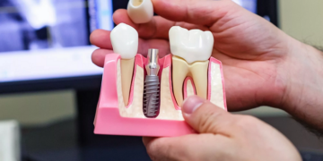 Имплантация зубов: правила и некоторые рекомендации