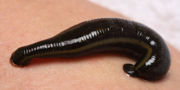 Особенности лечения разных заболеваний с помощью пиявок