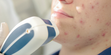 Особенности лечения угревой сыпи и несколько советов