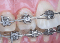 Встановлення брекет-систем: що потрібно знати та правила