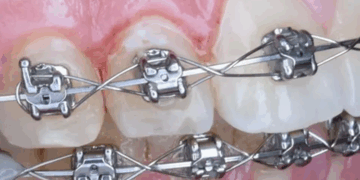Встановлення брекет-систем: що потрібно знати та правила