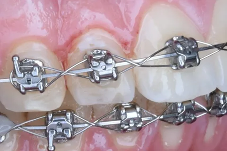 Встановлення брекет-систем: що потрібно знати та правила