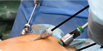 Подготовка правила и основные признаки удаления пахово-бедренных лимфоузлов